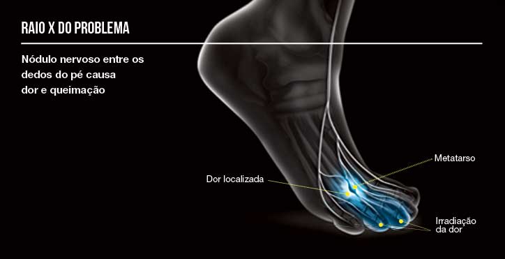 A PODOPOSTUROLOGIA TRATA NEUROMA DE MORTON